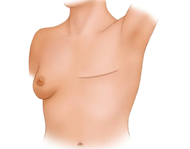 home care after mastectomy